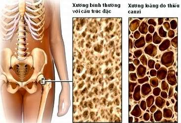 BỆNH CÒI XƯƠNG DO THIẾU VITAMIN D