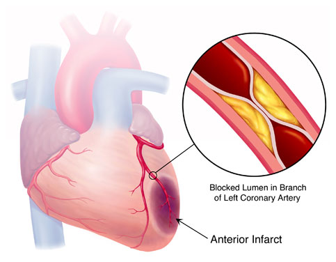 Thiết bị Kardiosens cảnh báo sớm nhồi máu cơ tim